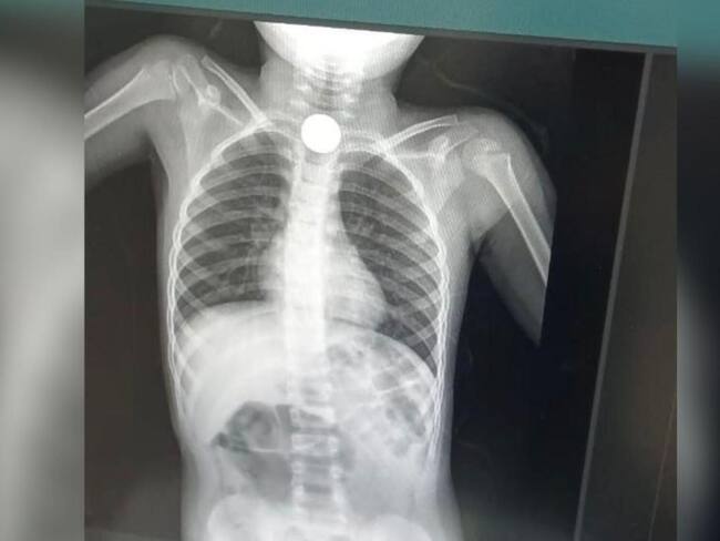 En el Magdalena un niño se tragó dos monedas familiares denuncian falta de atención