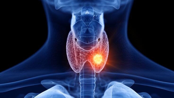 Tome nota: Síntomas del cáncer de tiroides explicado por una endocrinóloga