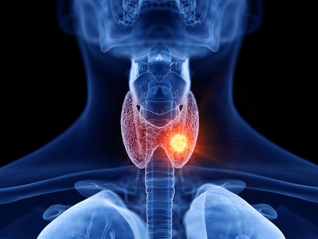 Tome nota: Síntomas del cáncer de tiroides explicado por una endocrinóloga