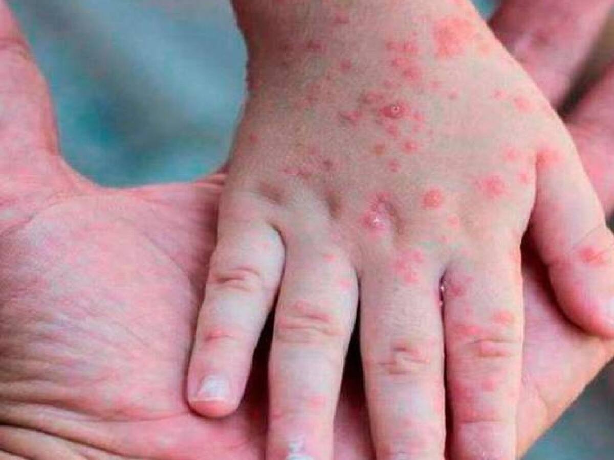 Descartan dos casos sospechosos de viruela Símica en Santander