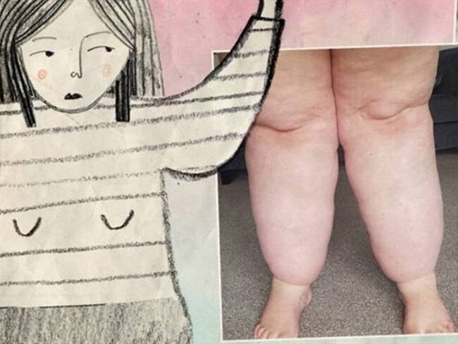 Afecta al 11% de mujeres.. Foto: BBC Mundo