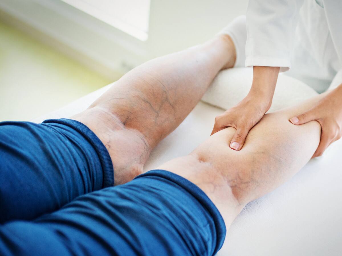 ¿No sabe como eliminar las varices? Cirujano vascular reveló el secreto