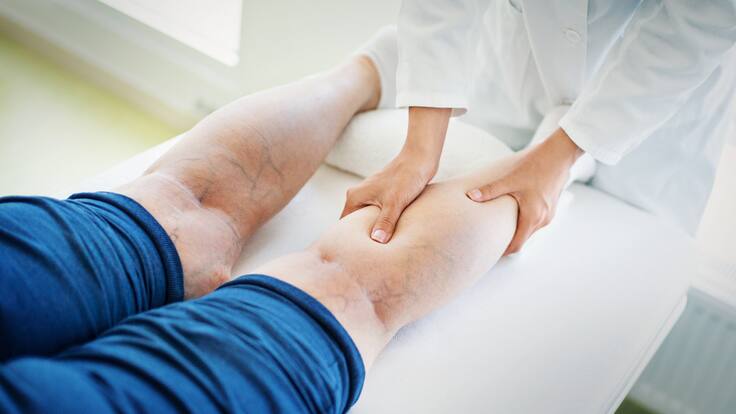 ¿No sabe como eliminar las varices? cirujano vascular reveló el secreto