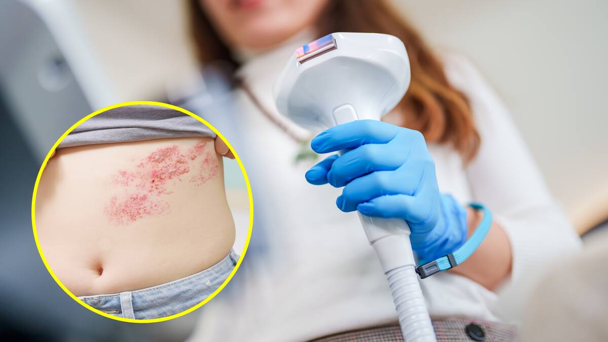 Profesional habló de la ‘Culebrilla’ o Herpes Zóster, la enfermedad que da despues de la varicela