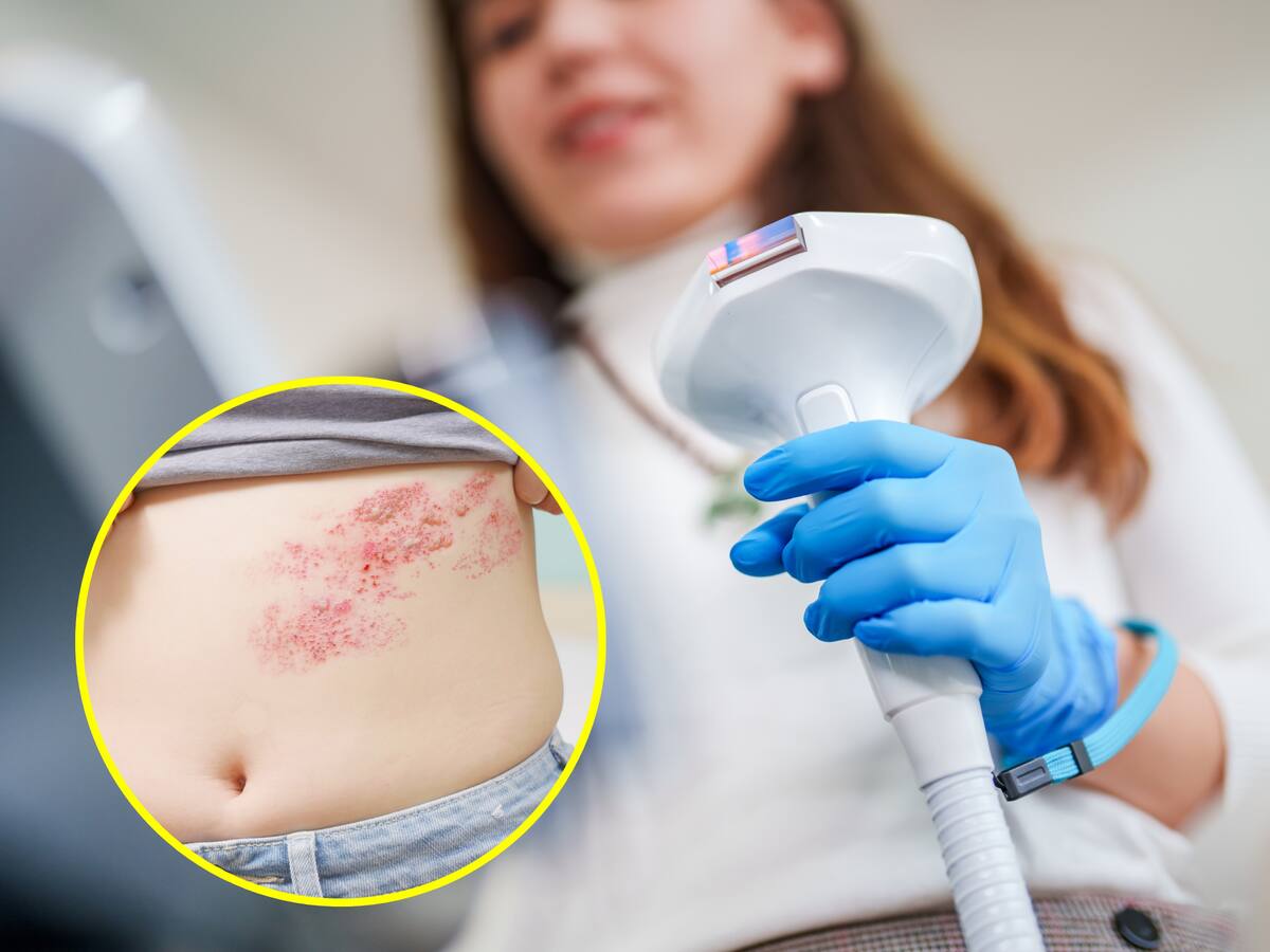 ¿Qué es la ‘culebrilla’ o herpes zóster? Experta explica enfermedad que da después de la varicela