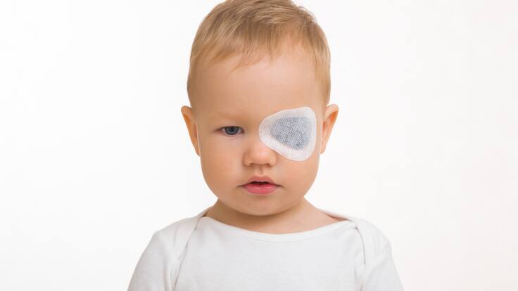 Ojo perezoso: ¿A qué edad debe ser tratado?, oftalmólogo explicó