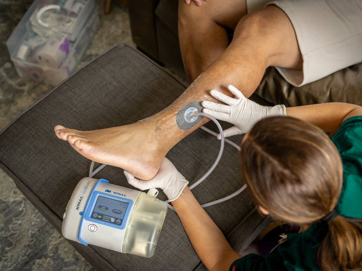 Terapia de presión negativa: ¿Cómo funciona para la curación de heridas y cicatrices? Explicación