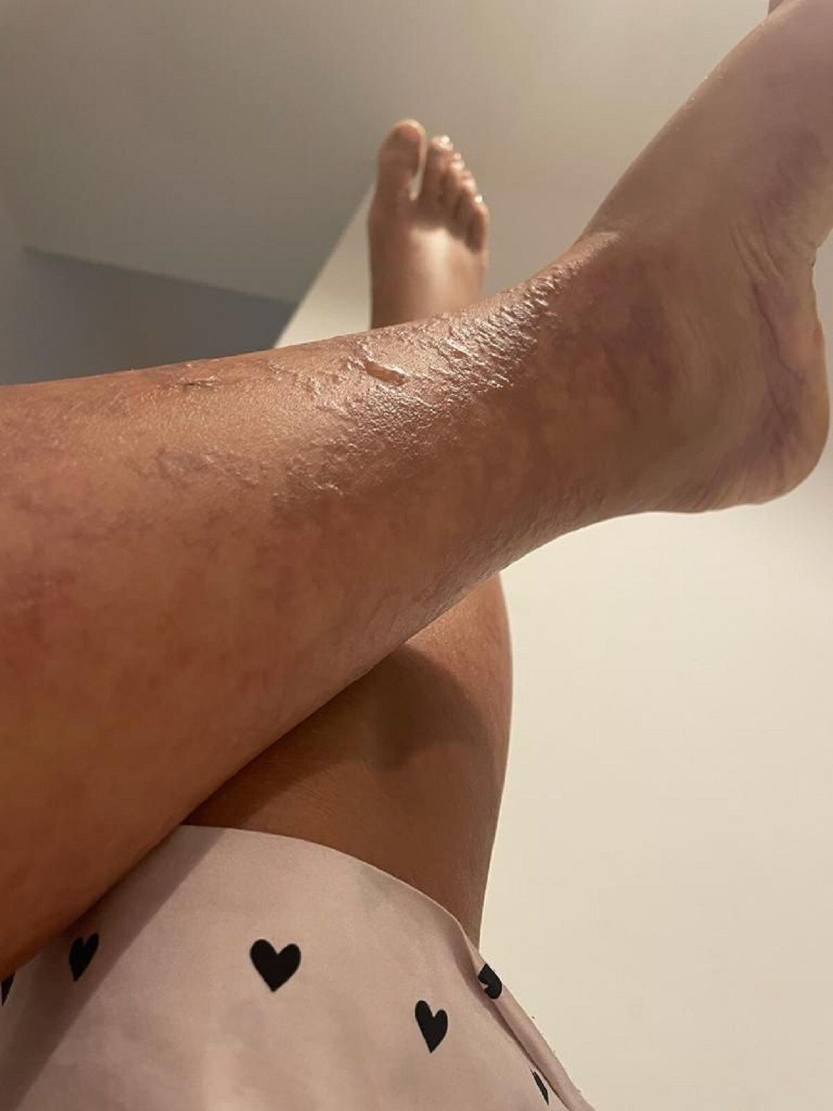 Quemaduras ocasionadas en una cámara de bronceo. Crédito: Imagen suministrada por el abogado, Juan Camilo Puerta.