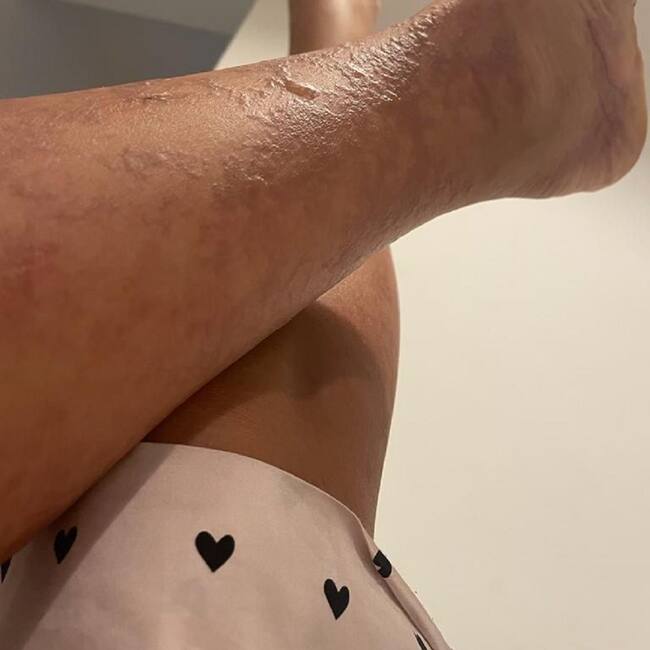 Quemaduras ocasionadas en una cámara de bronceo. Crédito: Imagen suministrada por el abogado, Juan Camilo Puerta.