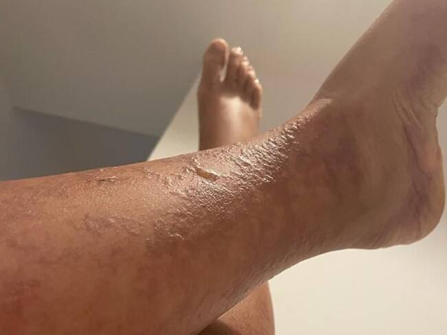 Quemaduras ocasionadas en una cámara de bronceo. Crédito: Imagen suministrada por el abogado, Juan Camilo Puerta.