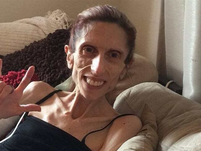 Rachael Farrokh, de 39 años y apenas 20kg de peso, ha hecho del signo no verbal del amor su símbolo para expresar optimismo y agradecimiento.. Foto: BBC Mundo