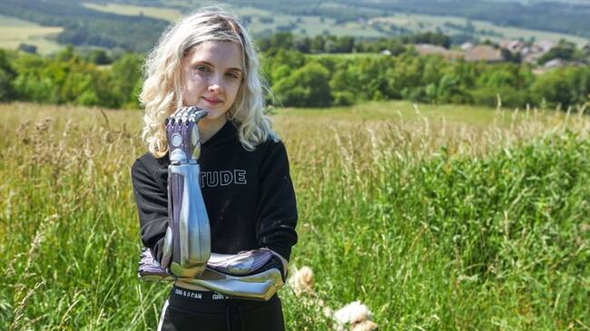 Tilly Lockey, de 15 años, perdió sus manos y antebrazos cuando solo tenía un año de nacida.. Foto: Getty Images
