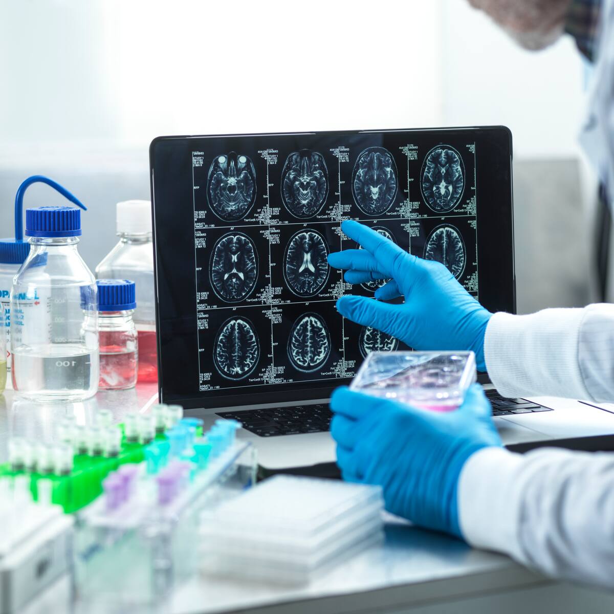 ¿Se puede prevenir el Alzhéimer desde una edad temprana? Neurólogo explicó los síntomas de alarma