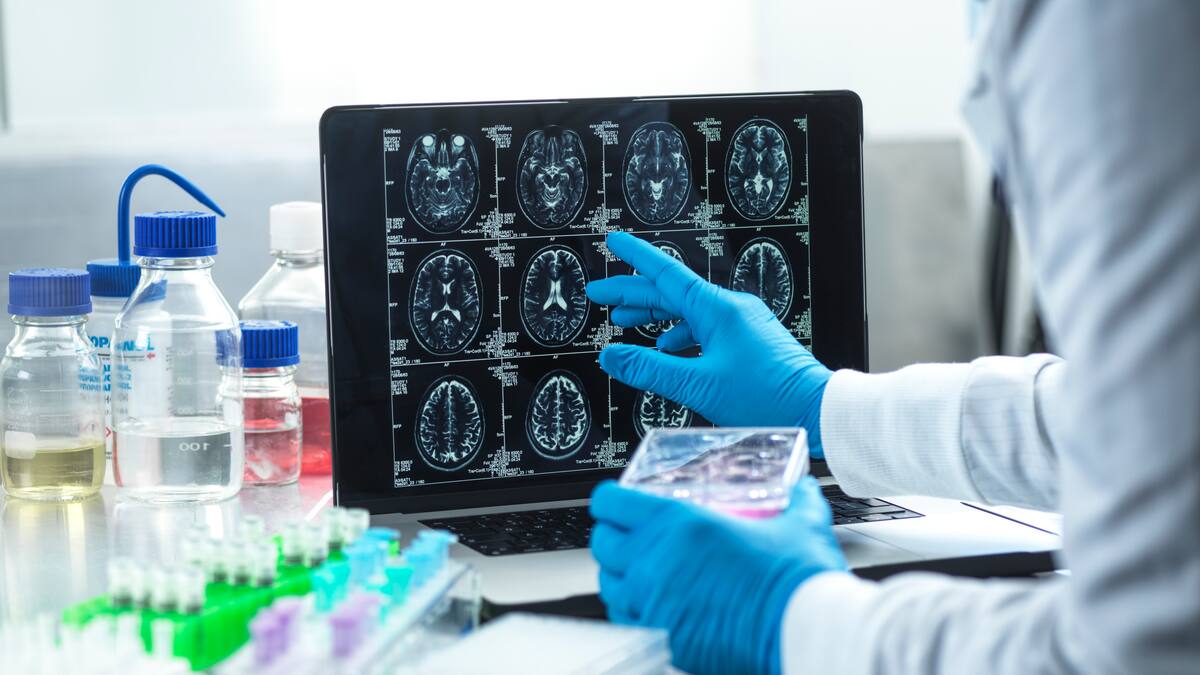 ¿Se puede prevenir el Alzhéimer desde una edad temprana? Neurólogo explicó los síntomas de alarma