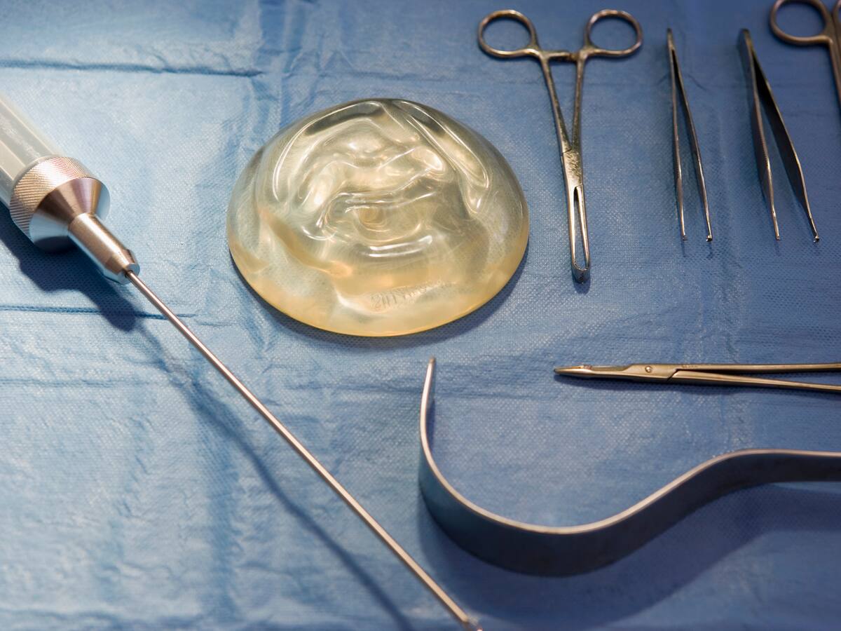 Implantes mamarios: ¿Es verdad que ya no es necesario quitarlos?