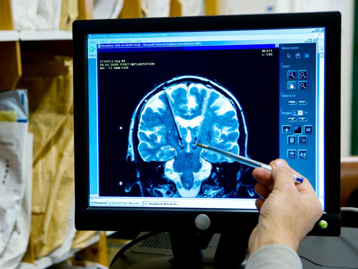 Implante cerebral ayudaría a que pacientes con esclerosis lateral recuperen el habla