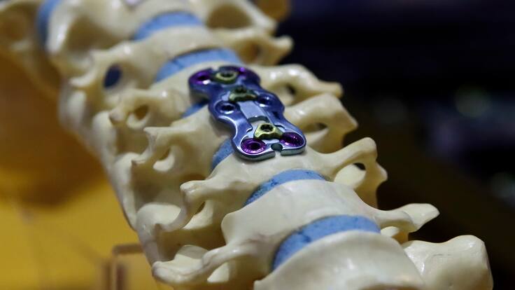 ¿Cuándo un dolor de espalda lleva a cirugía? Ortopedista explica signos de alarma