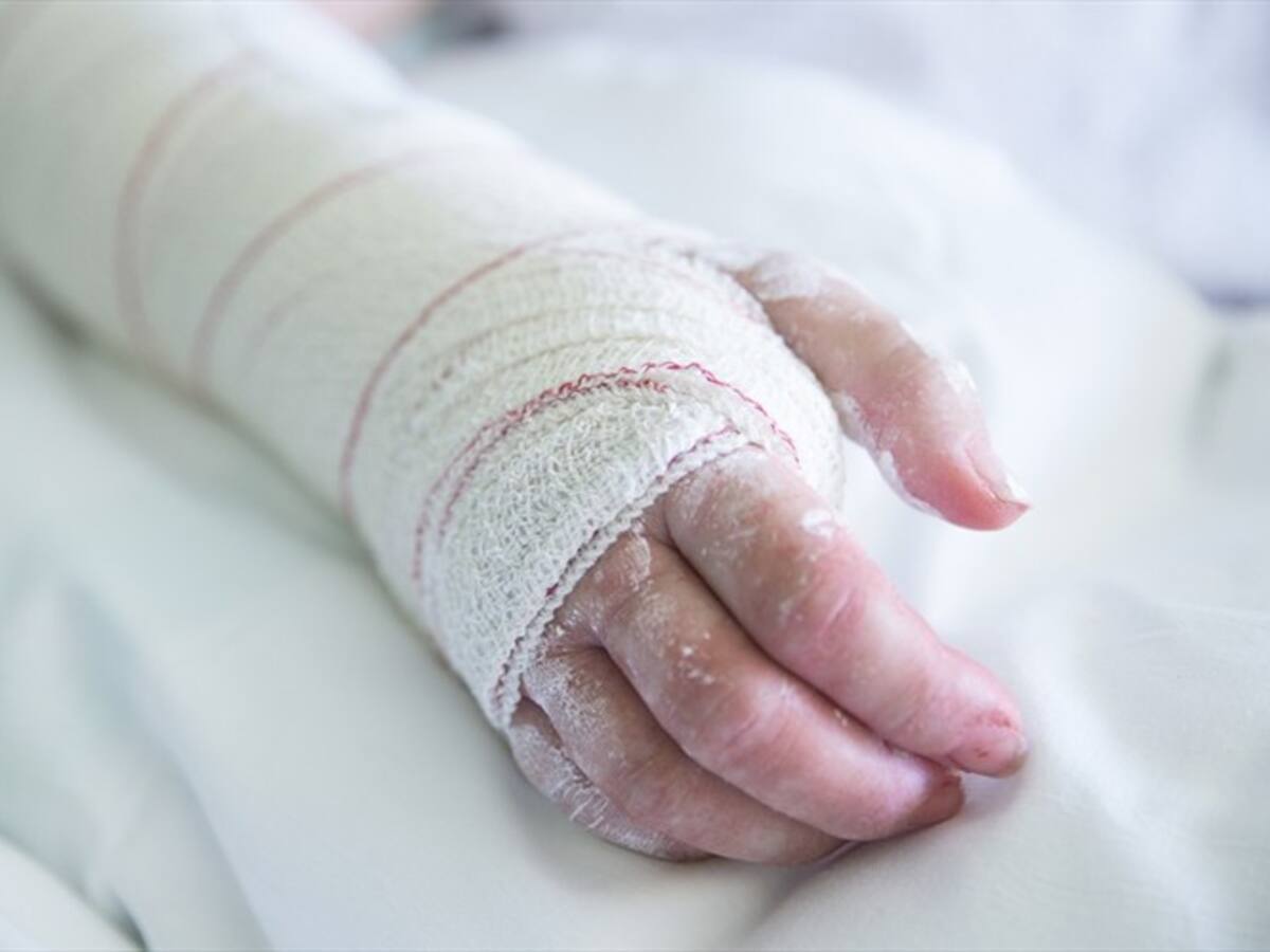 Número de quemados con pólvora en Colombia aumentó a 520