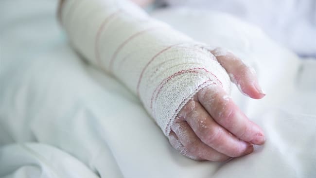 La Secretaría de Salud de Popayán hace seguimiento al caso de un niño de 7 años de edad que resultó quemado con pólvora. Foto: Getty Images