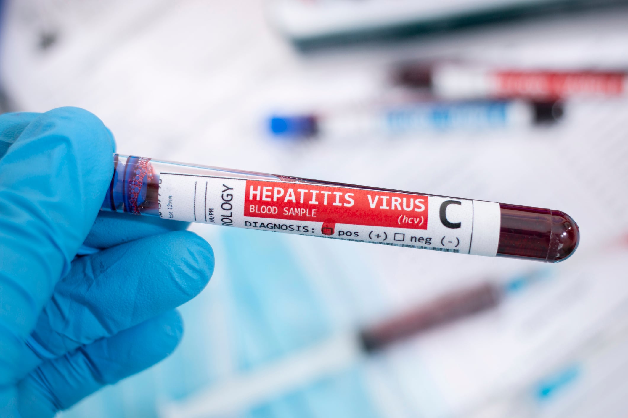 Hepatitis C virus, imagen de referencia. Foto: Getty Images