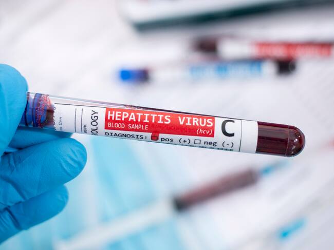 Hepatitis C virus, imagen de referencia. Foto: Getty Images