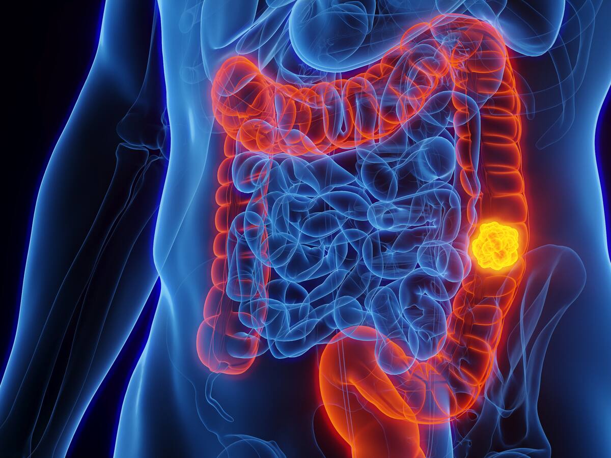 Experto explica qué hábitos hay que cambiar para evitar el cáncer de colon