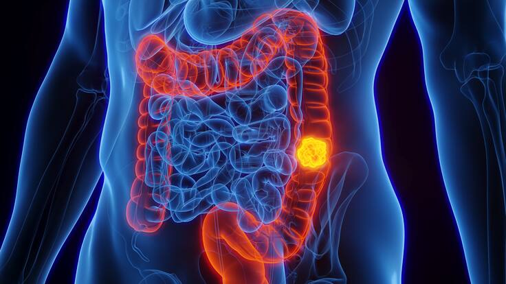 Experto explica qué hábitos hay que cambiar para evitar el cáncer de colon