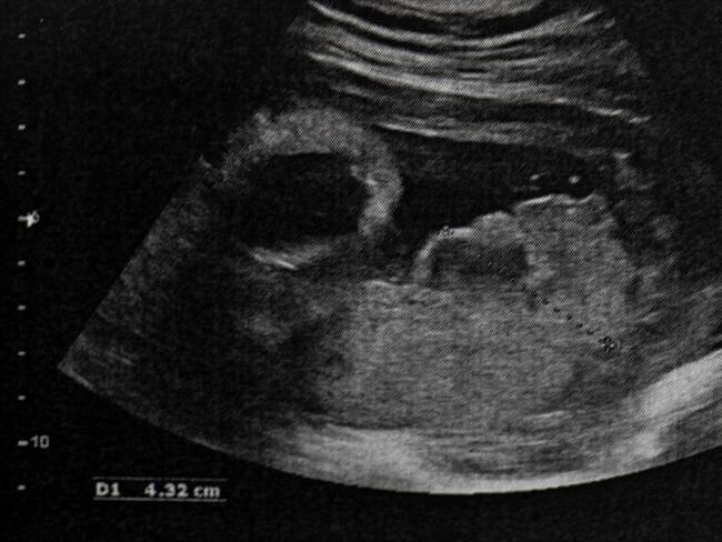 Despenalización total del aborto: ¿Colombia está lista?