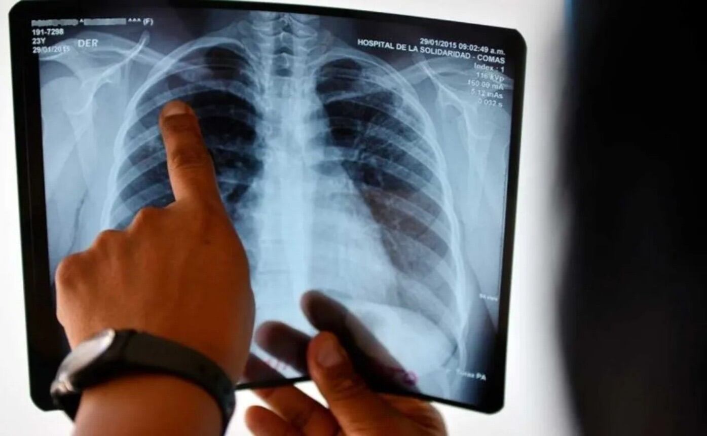 Casos de tuberculosis en Pereira / Foto: AFP
