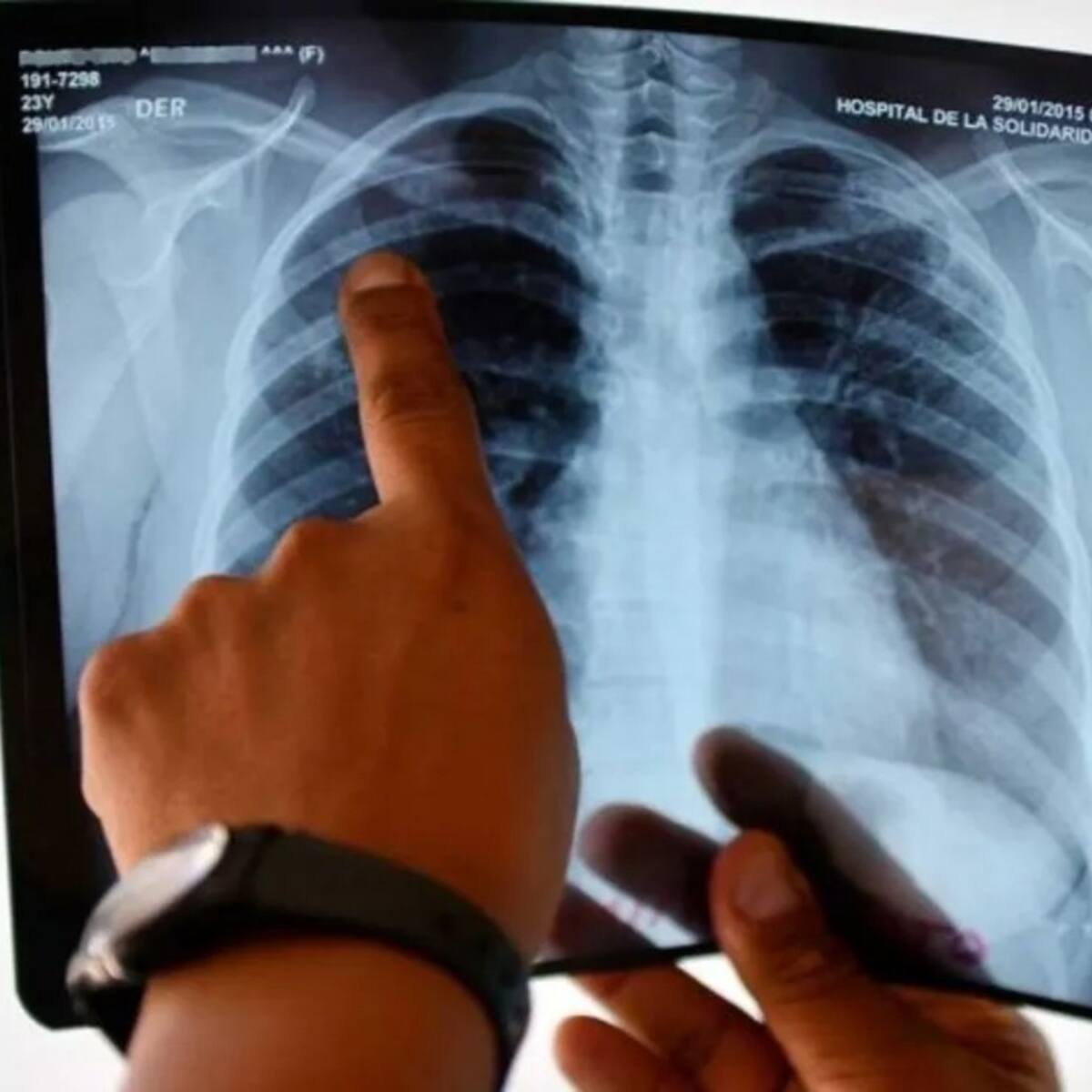 Alerta en Norte de Santander por aumento de casos de tuberculosis
