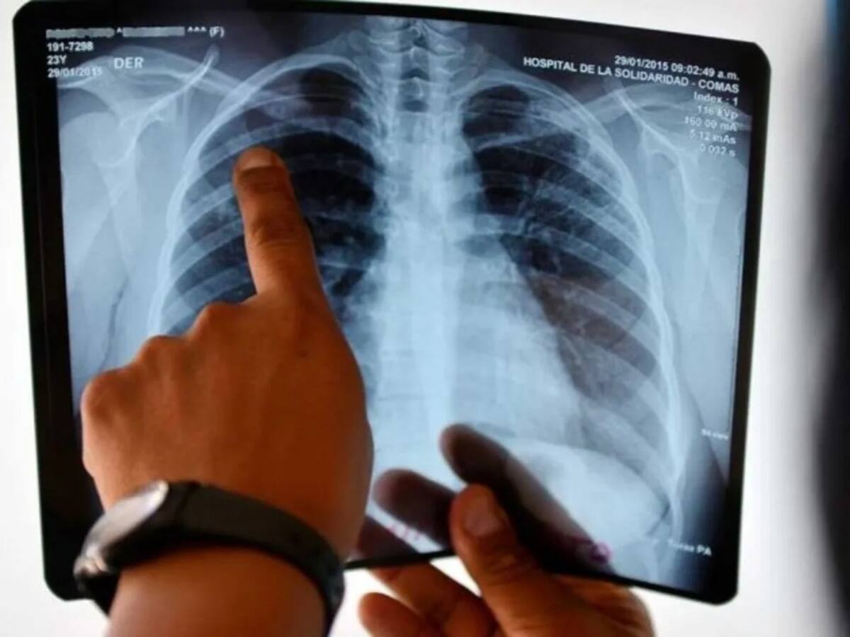 Un fallecimiento y tres casos de tuberculosis generan alerta en la UPPV de Pereira