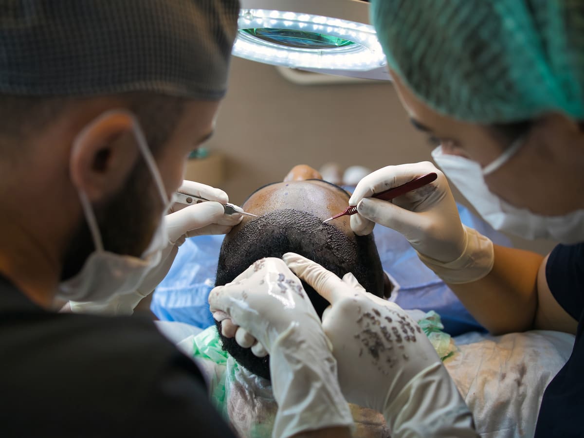 ¿En qué casos es recomendable un trasplante capilar?