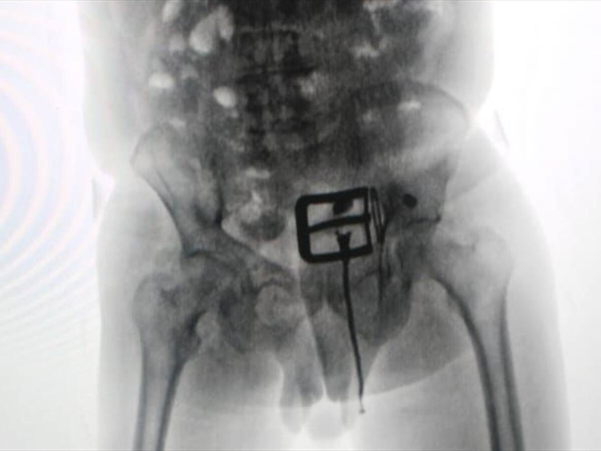 Capturan a un hombre con más de 1 kilo de cocaína en su estómago