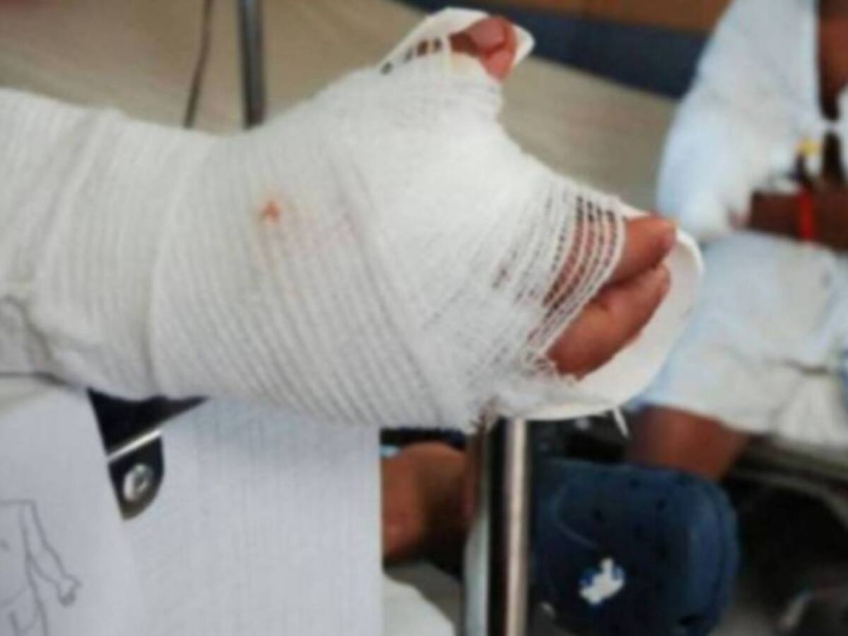 ¿Cuál es el parte médico de niñas que sufrieron quemaduras en sus rostros en Tunja?