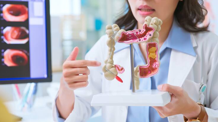 ¿Cuál es la edad adecuada para realizarse una colonoscopia? Gastroenteróloga explicó