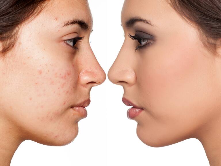 ¿Cuál es la manera correcta de maquillarse para evitar acné? W Radio