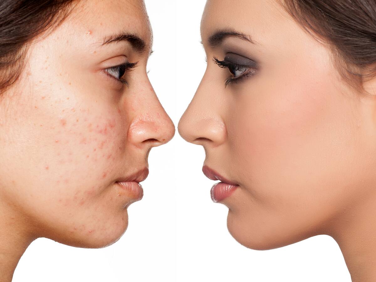 ¿Cuál es la manera correcta de maquillarse para evitar acné?