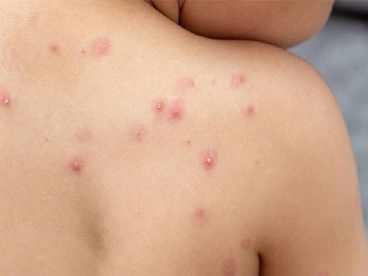 Descartan caso sospechoso de viruela del mono en Santa Marta