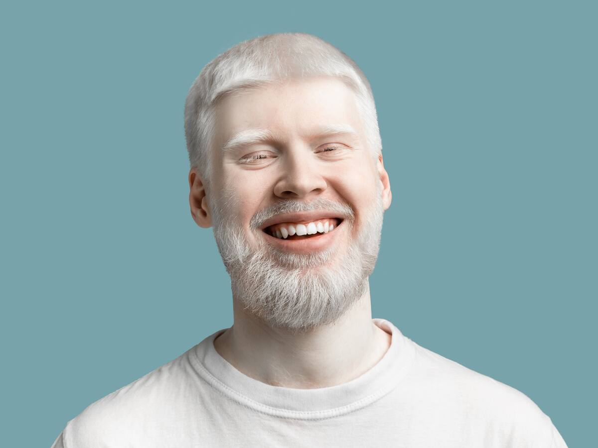 ¿Cuáles son los tipos de albinismo? Genetista explicó