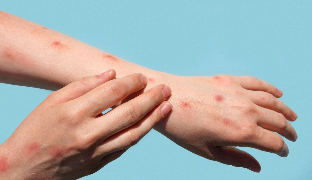 Imagen de referencia de viruela del mono. Foto: Getty Images.