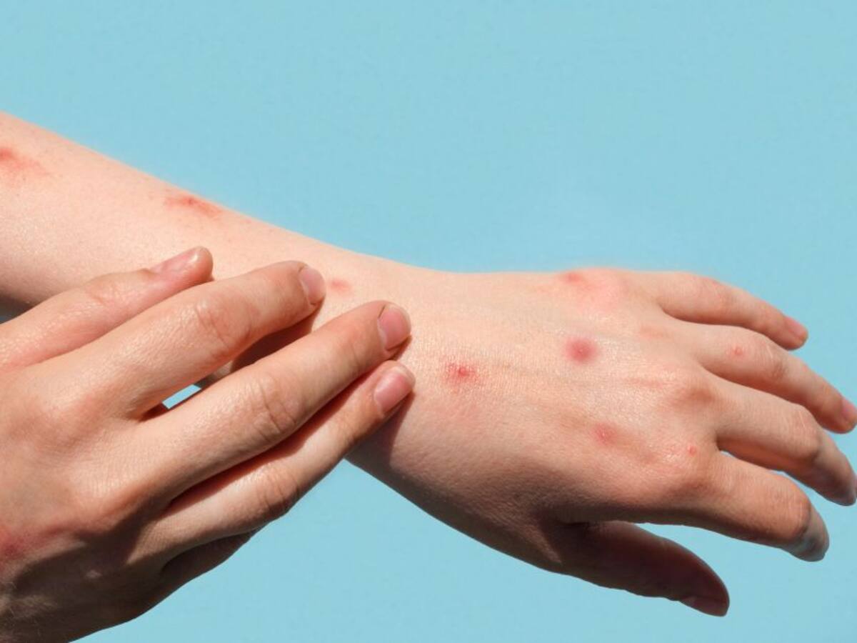 Se confirmó el primer caso de viruela del mono en el Huila