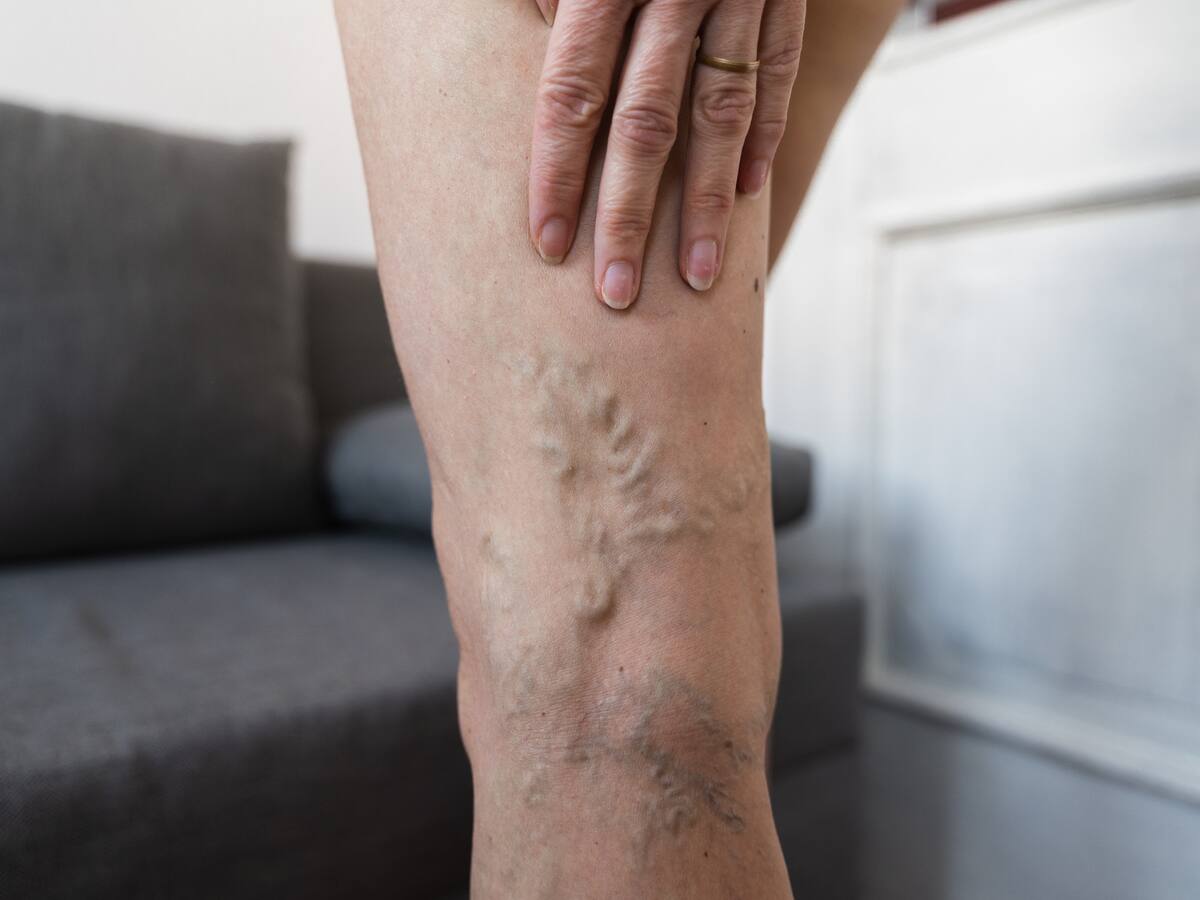 ¿Por qué salen las várices y qué riesgos tienen?