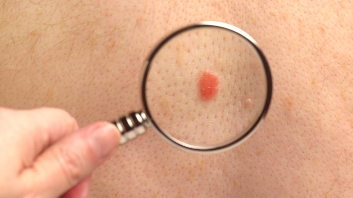 ¿El cáncer de piel es hereditario?: Experta responde y revela la manera de identificarlo