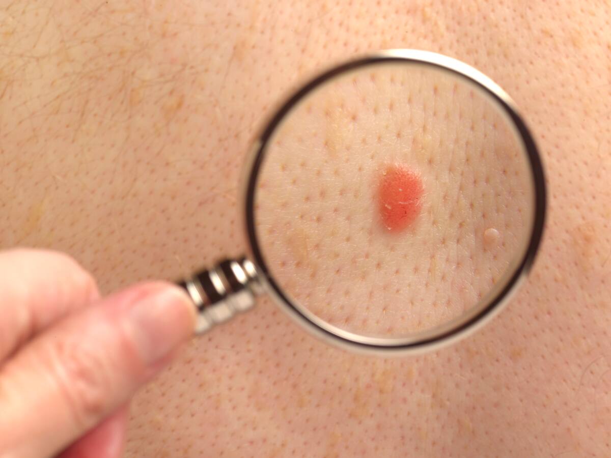 ¿El cáncer de piel es hereditario?: Experta responde y revela la manera de identificarlo