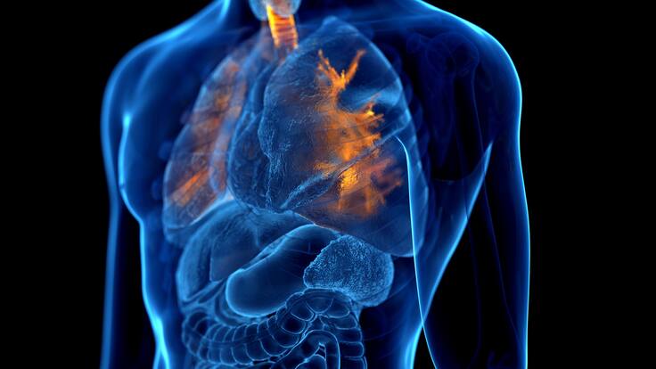 ¿Cómo saber si padece EPOC? La común enfermedad que dificulta la respiración