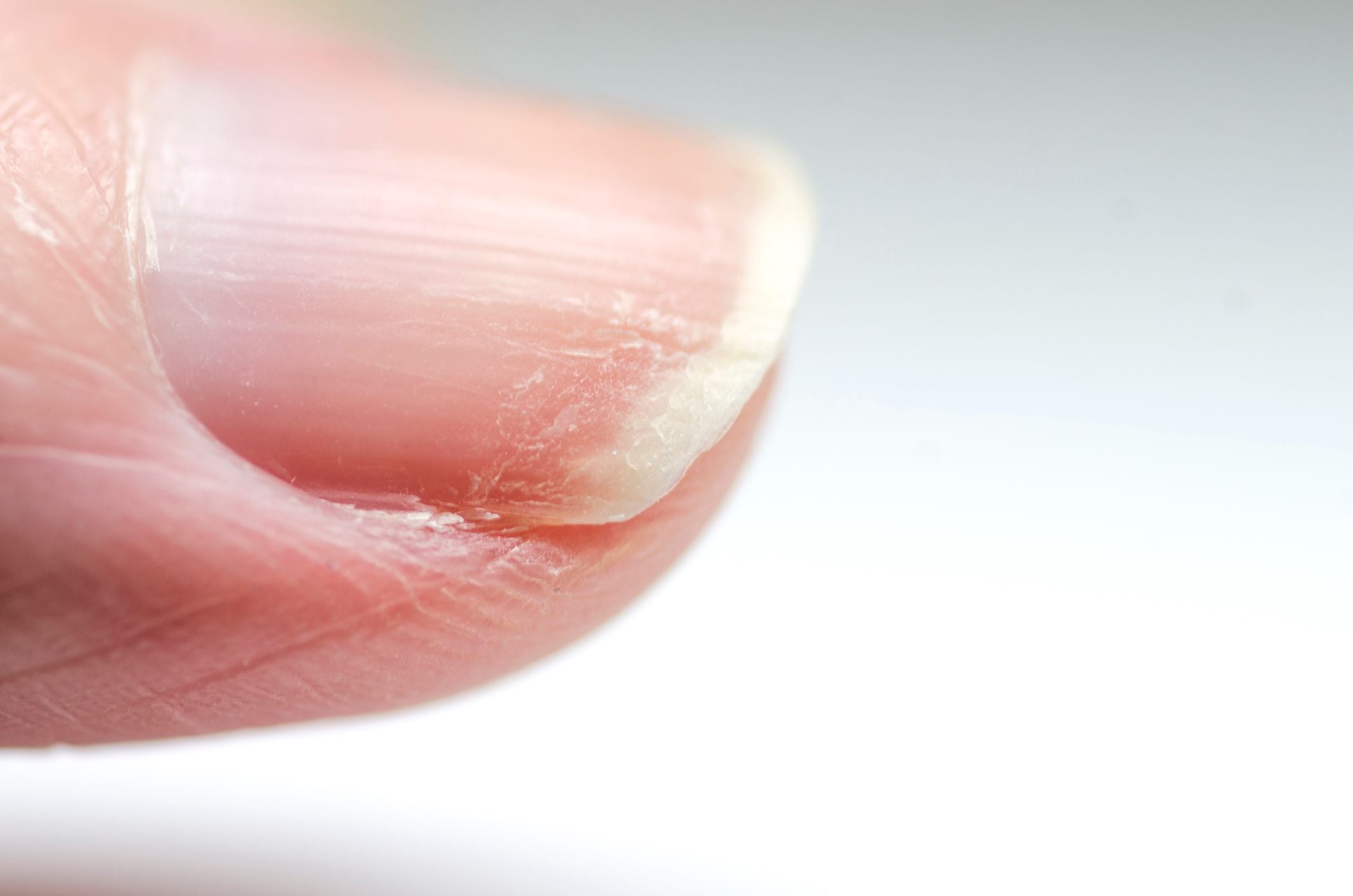 Manchas blancas en las uñas - GettyImages 