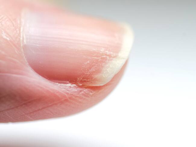 Manchas blancas en las uñas - GettyImages
