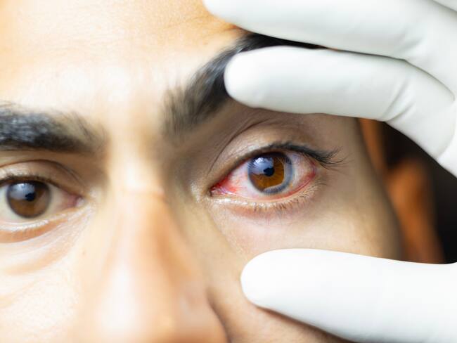 ¿Practicar deporte daña la salud visual? Optómetra habló sobre posibles riesgos