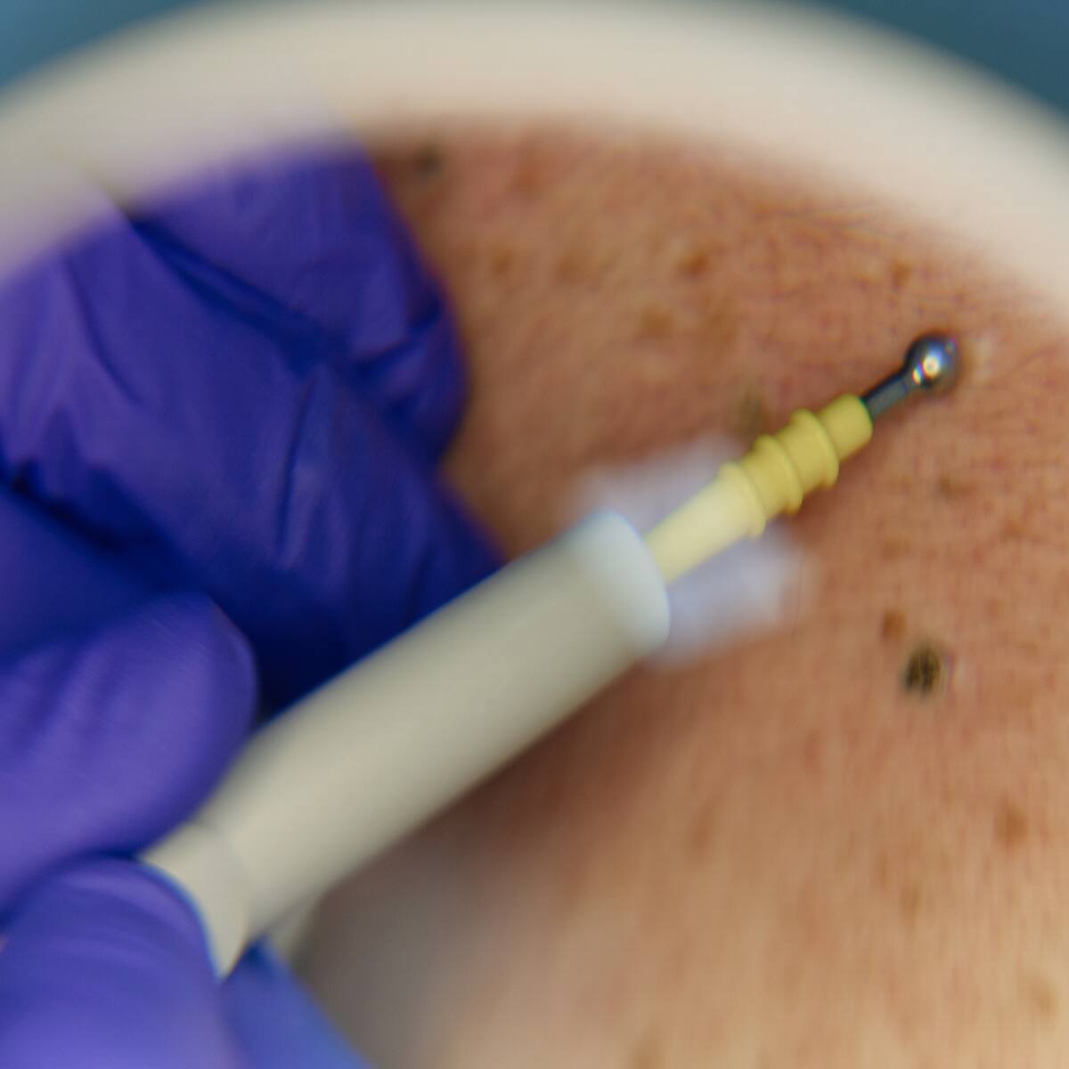 El 100% de las verrugas genitales son manejables: sexólogo