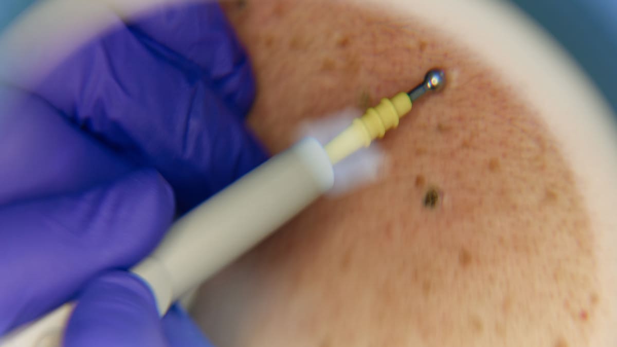 El 100% de las verrugas genitales son manejables: sexólogo